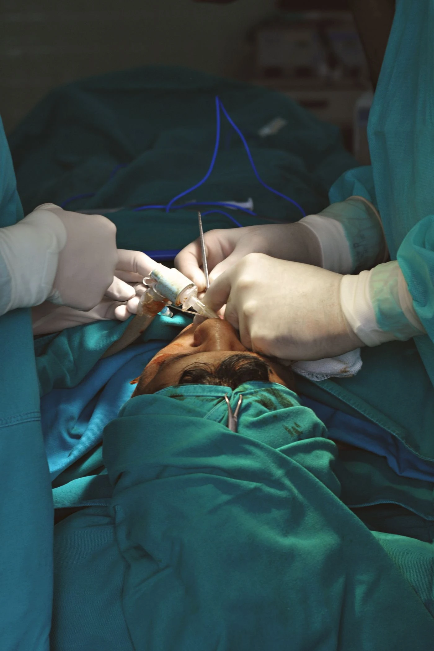 PRK Laser Eye Surgery