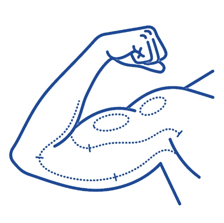 Arm Lift (Brachioplasty)
